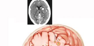 Metastatik Beyin Tümörleri
