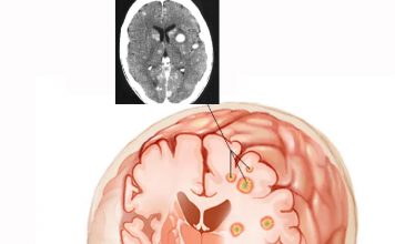 Metastatik Beyin Tümörleri