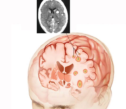 Metastatik Beyin Tümörleri