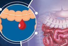 Alt Gastrointesinal Sistem Kanamaları