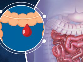 Alt Gastrointesinal Sistem Kanamaları