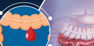 Alt Gastrointesinal Sistem Kanamaları