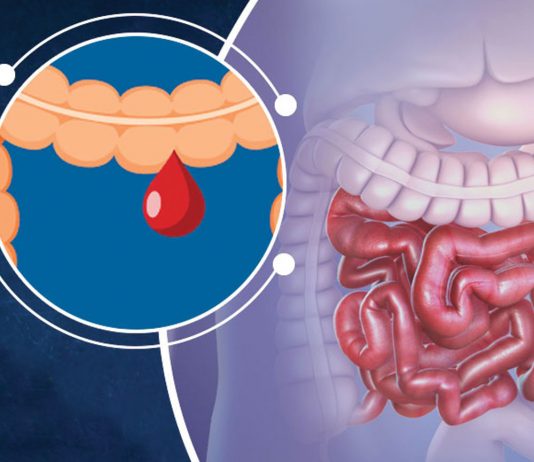 Alt Gastrointesinal Sistem Kanamaları