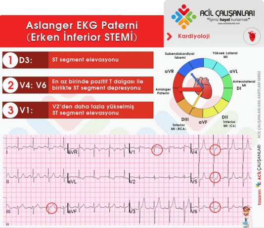 Aslanger EKG Paterni Erken İnferior STEMİ