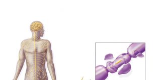 Güllien-Barre Sendromu (GBS)