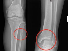 Maisonneuve Kırığı