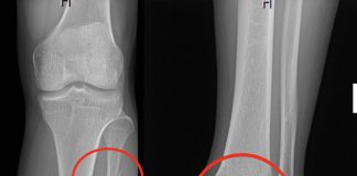 Maisonneuve Kırığı