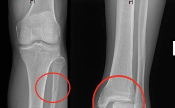 Maisonneuve Kırığı