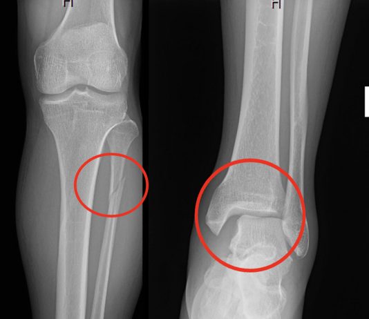 Maisonneuve Kırığı