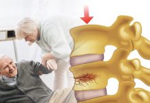 Vertebral Kompresyon Kırığı