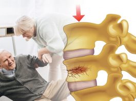 Vertebral Kompresyon Kırığı