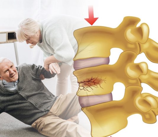 Vertebral Kompresyon Kırığı