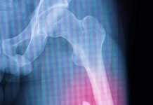 Femur Şaft Kırıkları