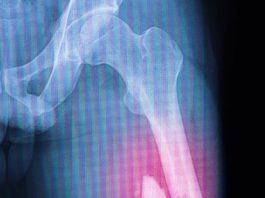 Femur Şaft Kırıkları