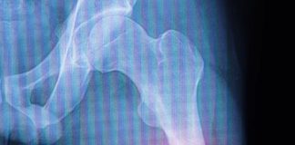 Femur Şaft Kırıkları