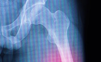 Femur Şaft Kırıkları