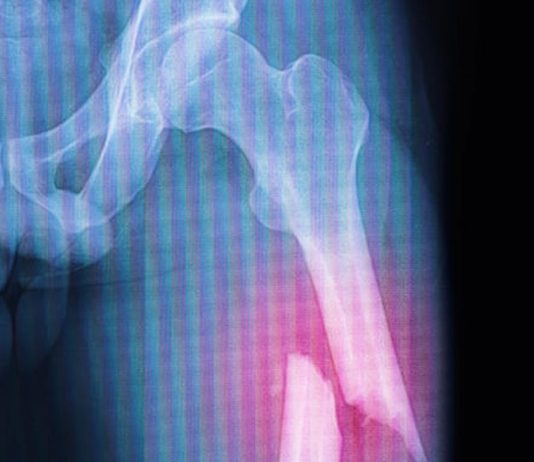 Femur Şaft Kırıkları