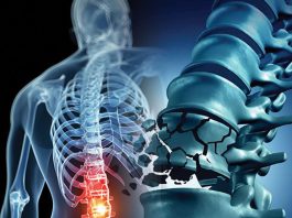 Vertebra Fraktürlerine Genel Yaklaşım