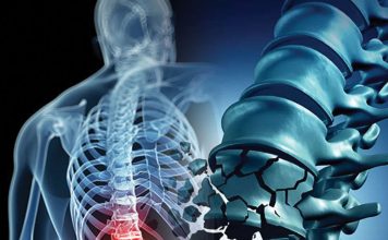 Vertebra Fraktürlerine Genel Yaklaşım