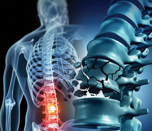 Vertebra Fraktürlerine Genel Yaklaşım