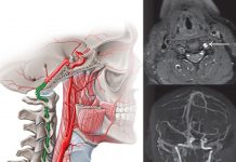 Vertebral Arter Diseksiyonu