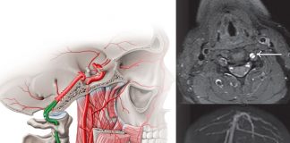 Vertebral Arter Diseksiyonu