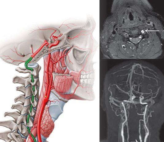 Vertebral Arter Diseksiyonu