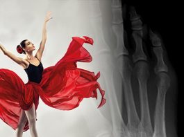 Dansçı (Pseudo Jones) Kırığı