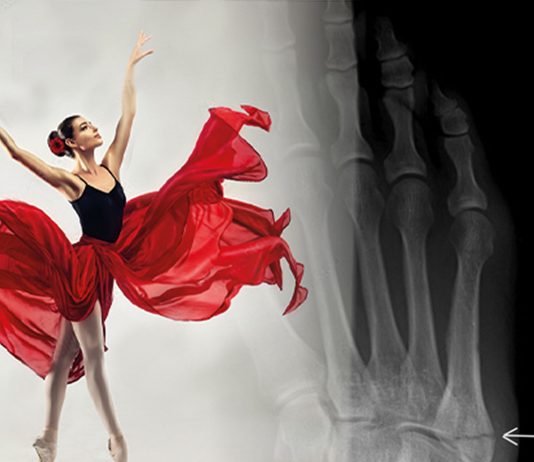 Dansçı (Pseudo Jones) Kırığı