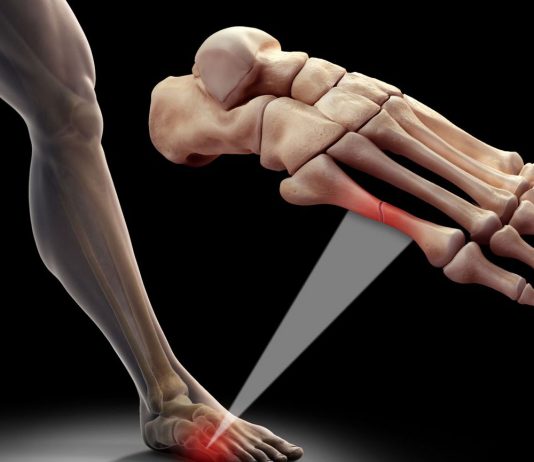 Metatars Kemik Kırıkları