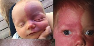 Sturge-Weber Sendromu