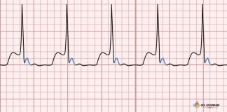 Atrioventriküler Nodal Reentry Taşikardi (AVNRT)