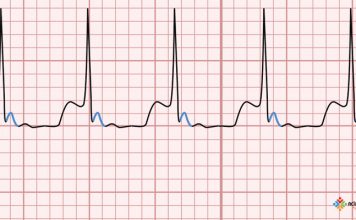 Atrioventriküler Nodal Reentry Taşikardi (AVNRT)
