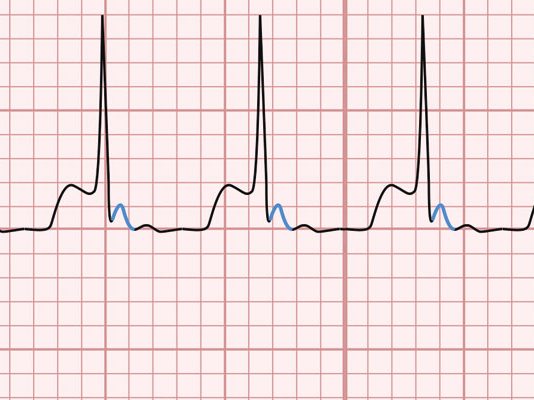 Atrioventriküler Nodal Reentry Taşikardi (AVNRT)