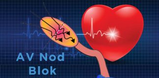 1. Derece Atriyoventriküler (AV) Blok