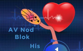 1. Derece Atriyoventriküler (AV) Blok
