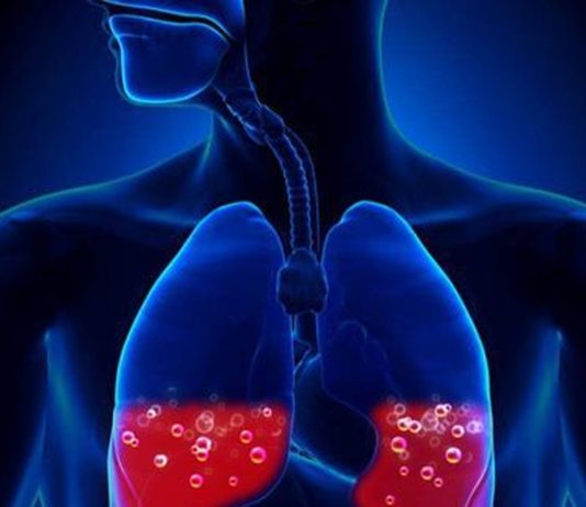 Kardiyojenik Pulmoner Ödem