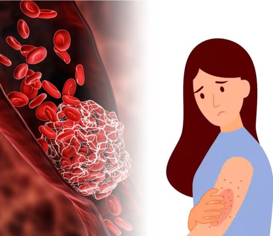 Trombotik Trombositopenik Purpura (TTP)