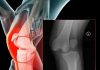 Diz Eklemi Çıkıklarına Genel Yaklaşım