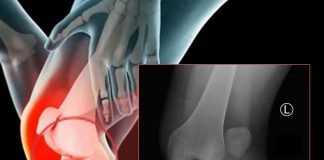 Diz Eklemi Çıkıklarına Genel Yaklaşım