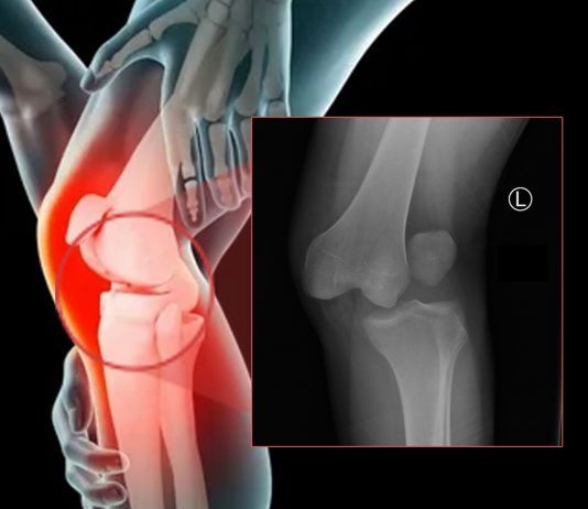 Diz Eklemi Çıkıklarına Genel Yaklaşım