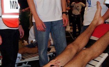 Egzersizle İlgili Senkop