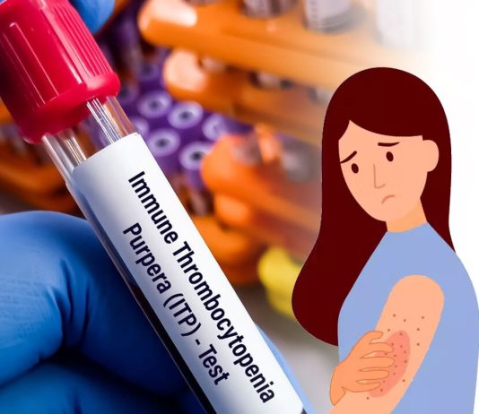 İdiyopatik Trombositopenik Purpura (İTP)