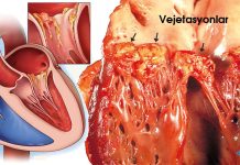 Endokardit Acil Yaklaşım
