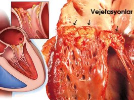 Endokardit Acil Yaklaşım