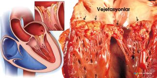 Endokardit Acil Yaklaşım