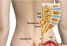 Pilonidal Sinüs Hastalığı Acil Yaklaşım