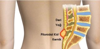 Pilonidal Sinüs Hastalığı Acil Yaklaşım