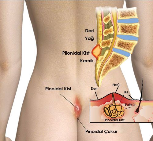 Pilonidal Sinüs Hastalığı Acil Yaklaşım