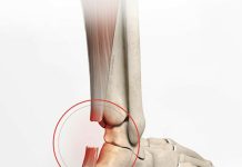 Aşil Tendon Rüptürü